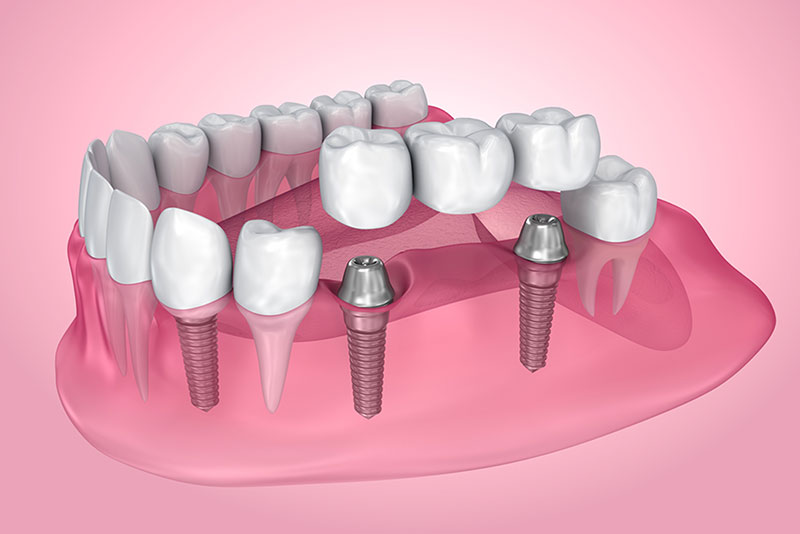 dental bridges in maple ridge