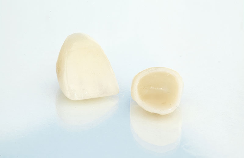 dental crowns in maple ridgle