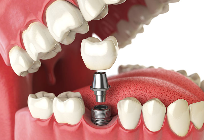 dental implants in maple ridge