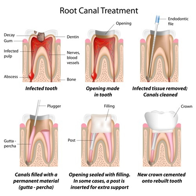 What are the different types of root canal treatment?, Dentist in Roswell,  GA, TruCare Dentistry Roswell