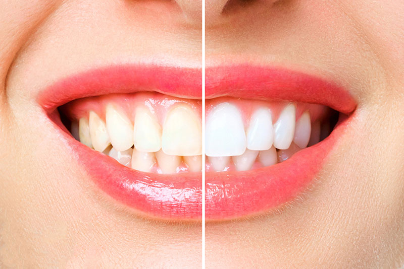 Maple Ridge Teeth Whitening