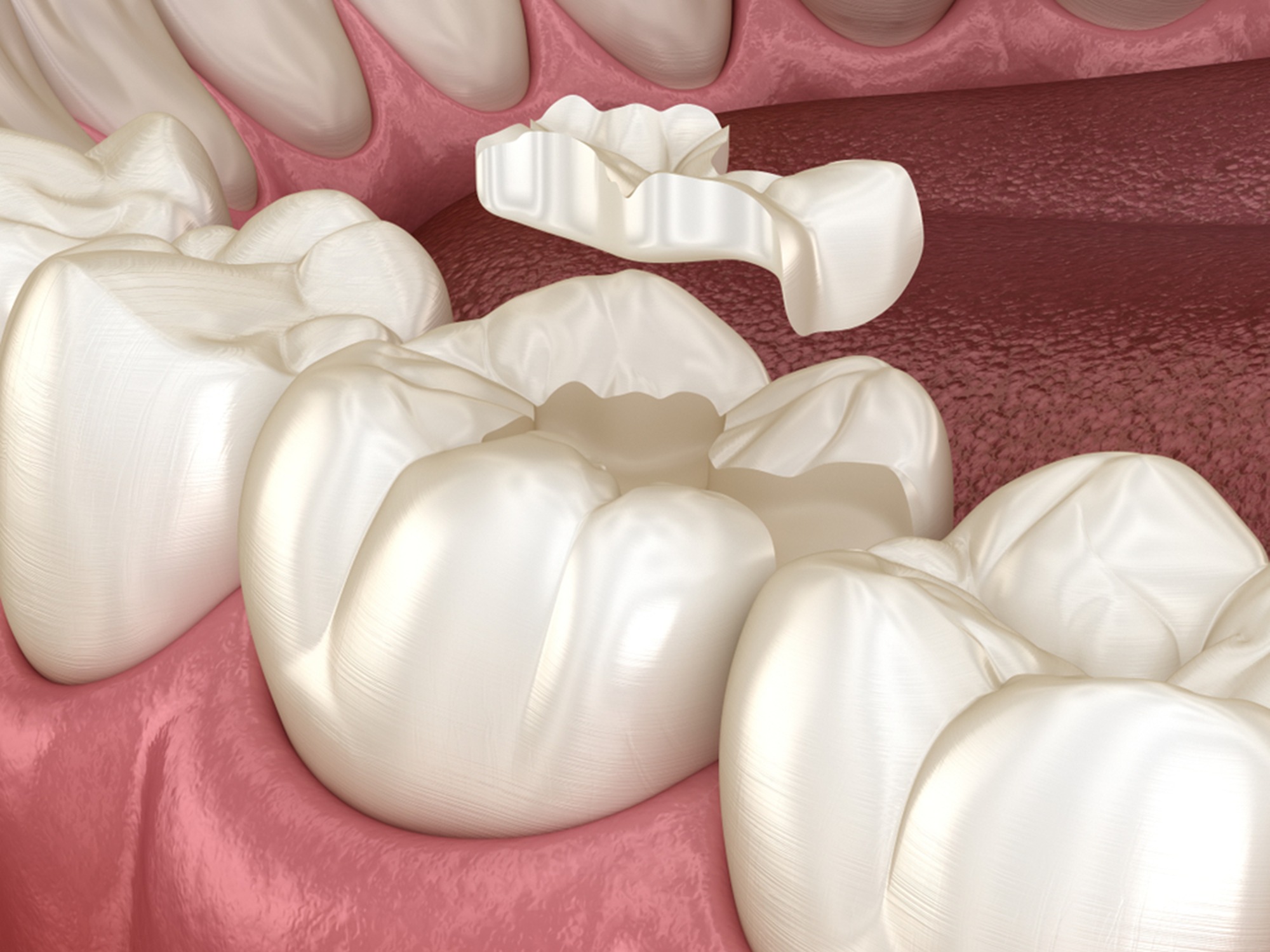 everything-you-should-know-about-dental-inlays-and-onlays