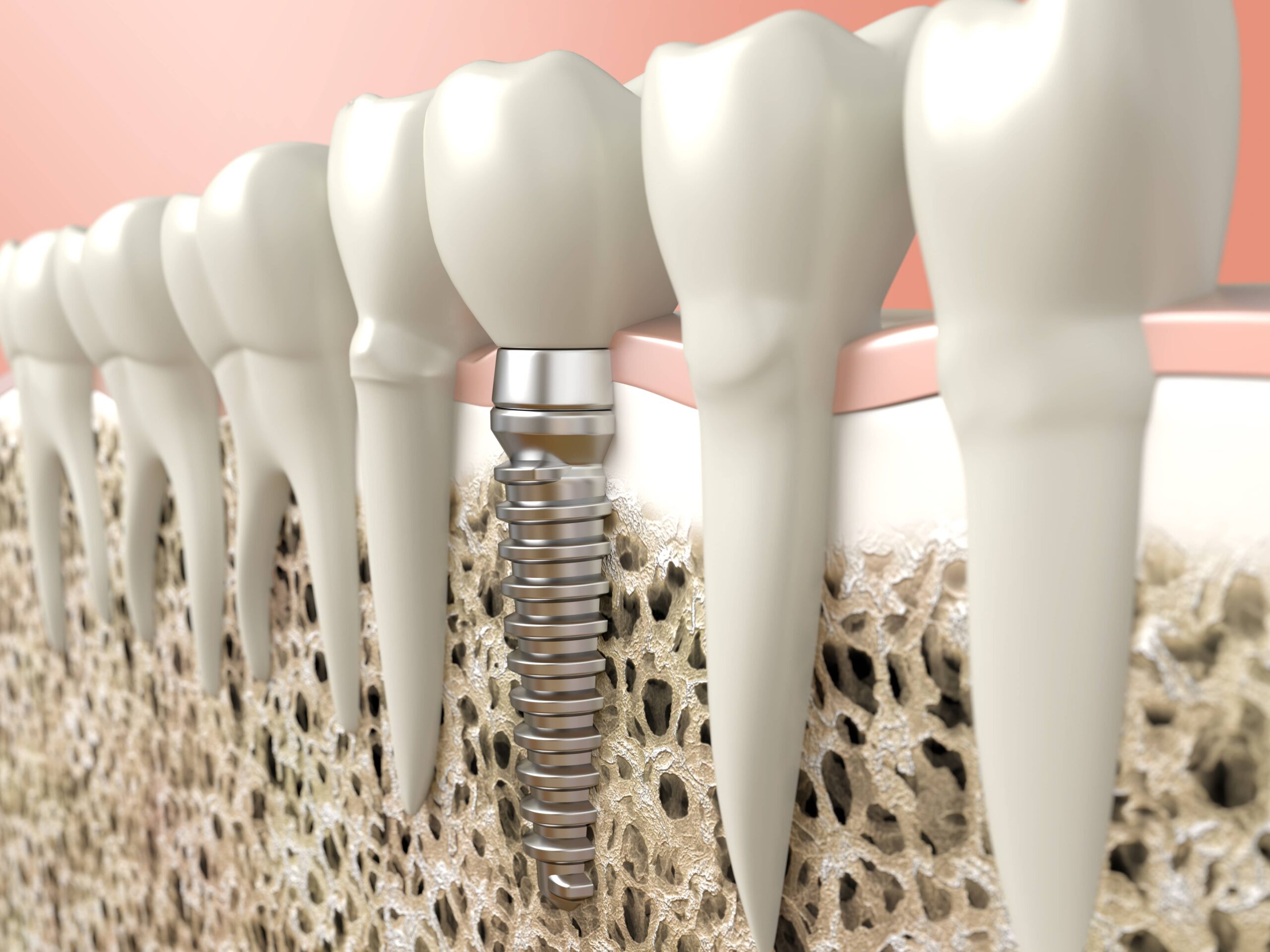 Graphical Representation of Dental implant by dentist in maple ridge